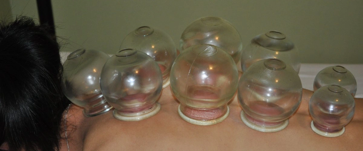 Cupping therapie - Acupunctuur Suzy Balen